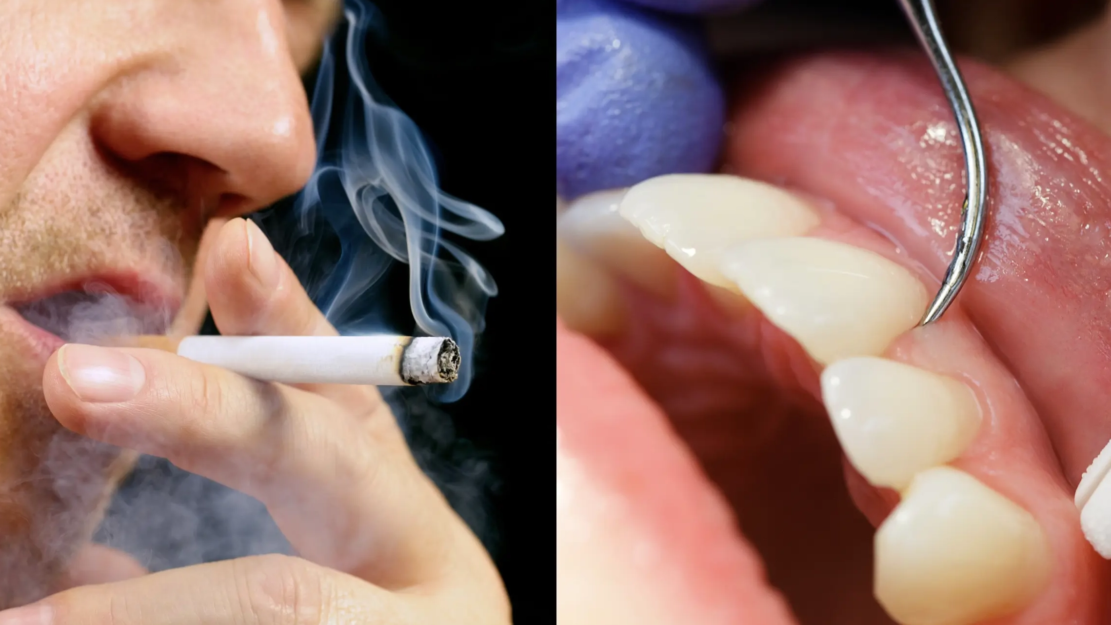 Dentist explains worrying reason why smokers and vapers could have gum disease without even realising
