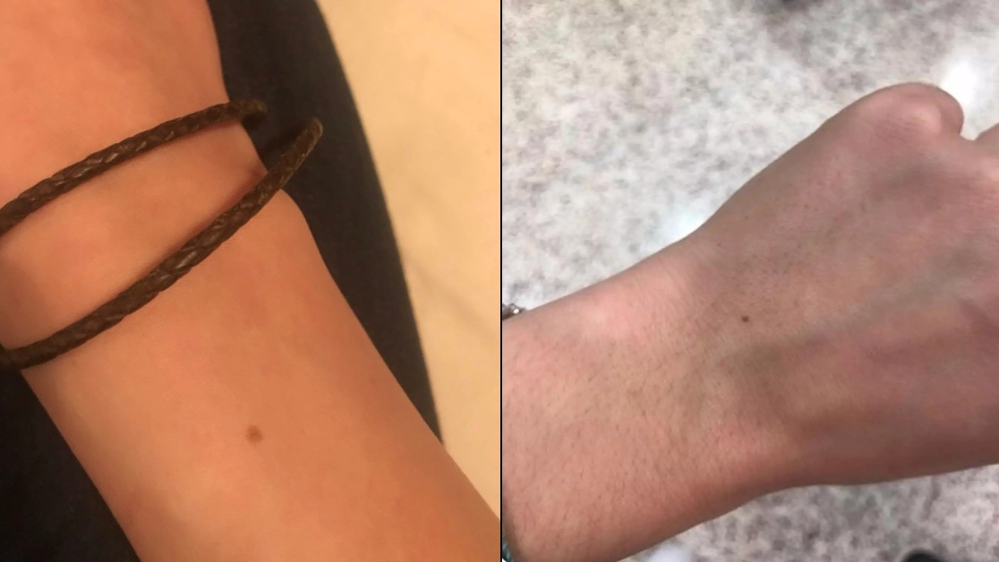 Reason so many people seem to have the exact same freckle