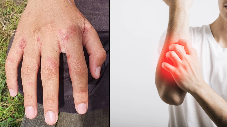 People warned that they might be dismissing victorian disease sweeping the UK with common skin problem
