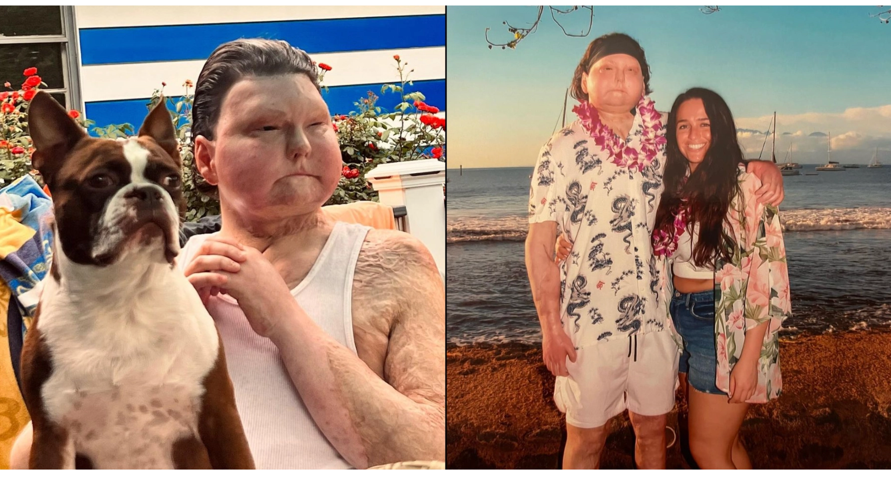 Girlfriend of man who had 'world's first face transplant' cruelly gets called 'gold digger'