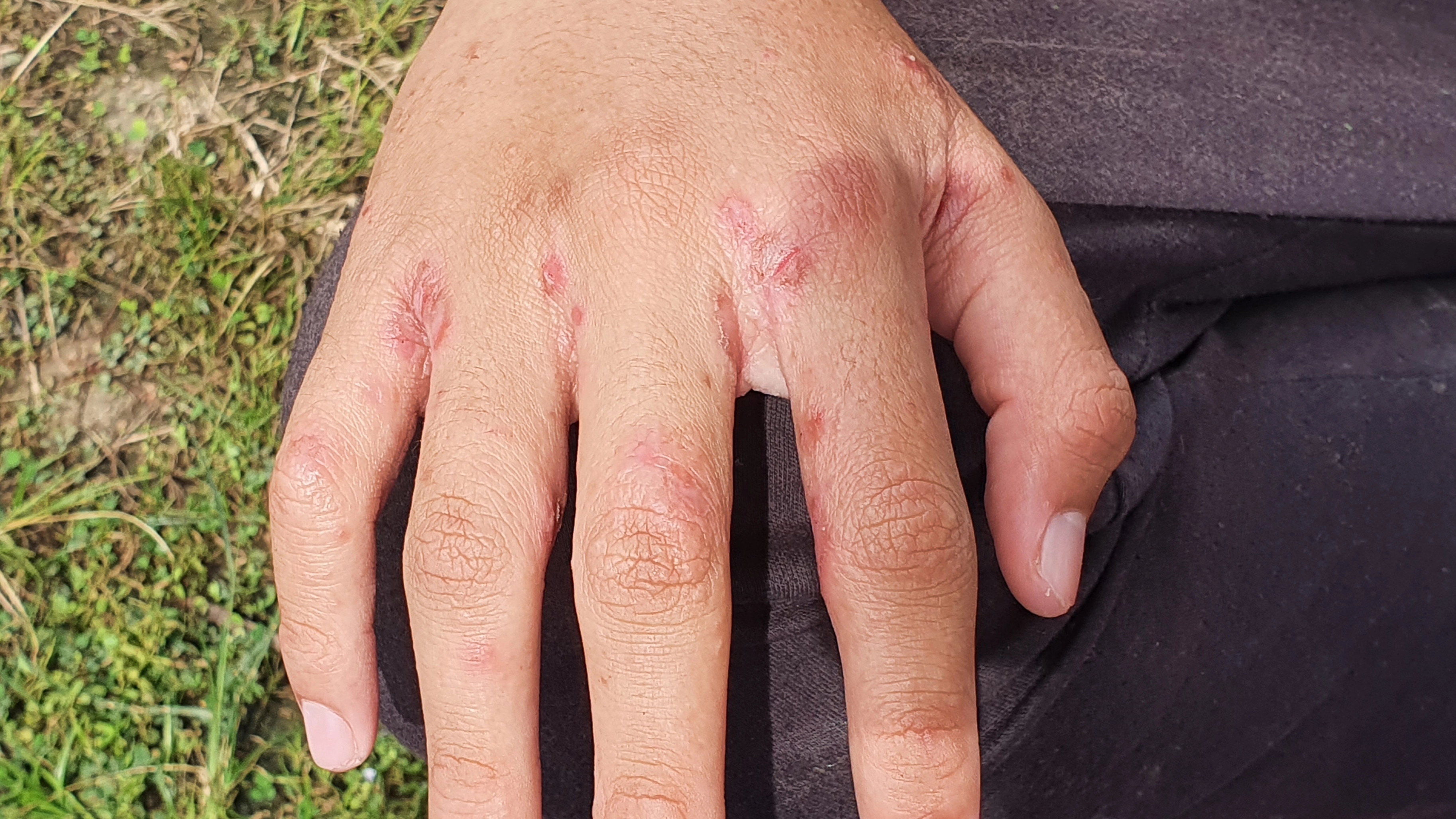 Doctors share concern about rise of Victorian disease in UK that comes with visible signs