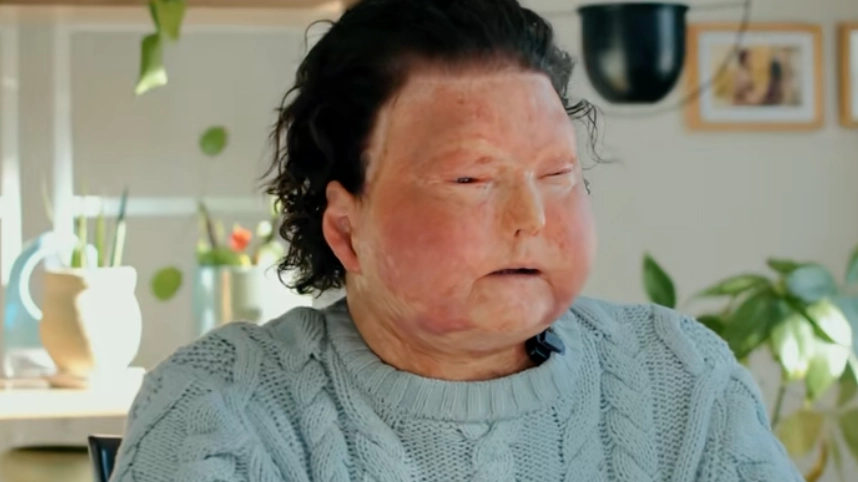 Man who had world's first successful face and double hand transplant explains how he survived accident