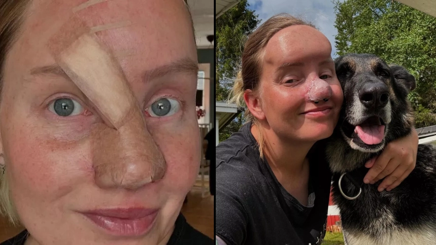 Woman who had nose bitten off by dog 'scared of firework' decides to keep pet