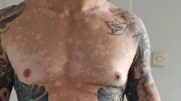 Man stopped sweating and lost all his hair months after getting tattoo with experts thinking colour of ink to blame