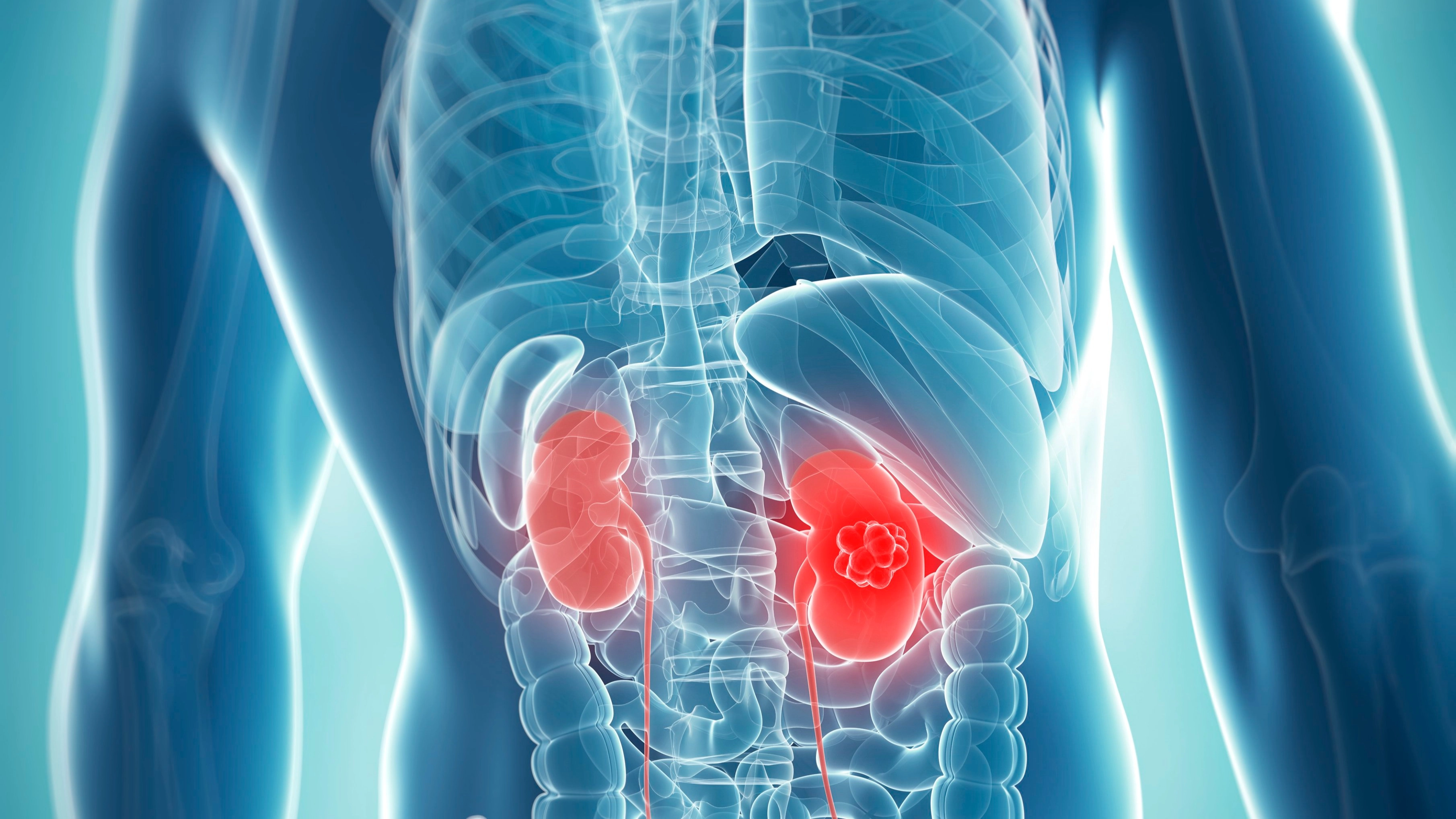 Common symptoms of kidney cancer to be aware of as cases are on rise