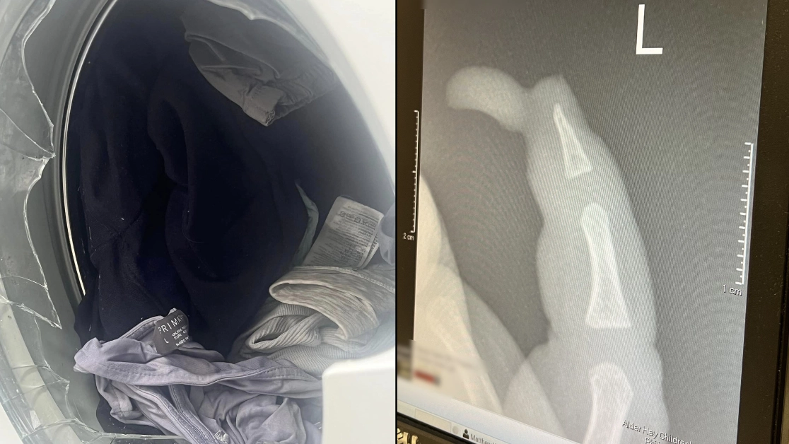 Mum claims toddler almost killed by exploding washing machine which left chunk of finger 'hanging off'