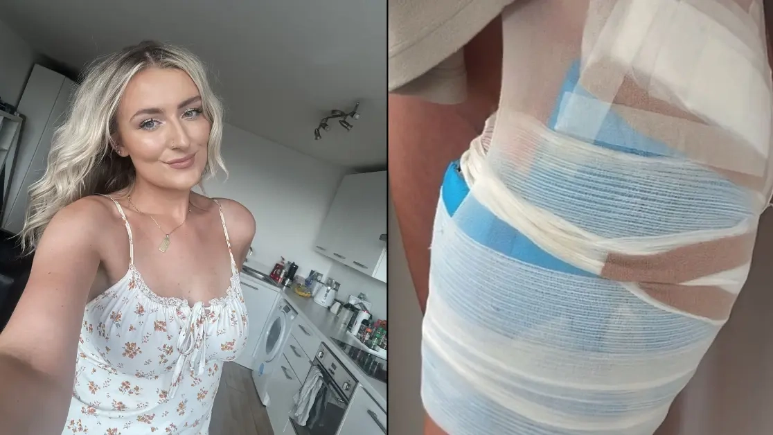 Woman 'burnt alive' after hot water bottle exploded onto her bare skin gives stark warning over using them in winter