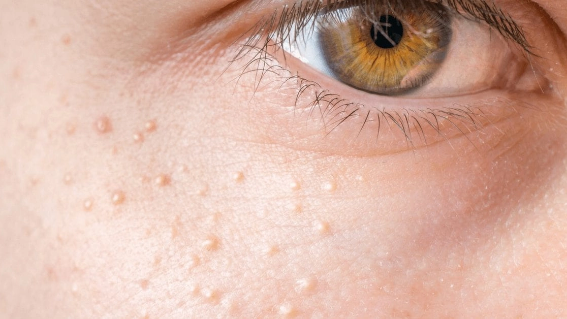 Meaning behind why people sometimes get small white spots across their bodies