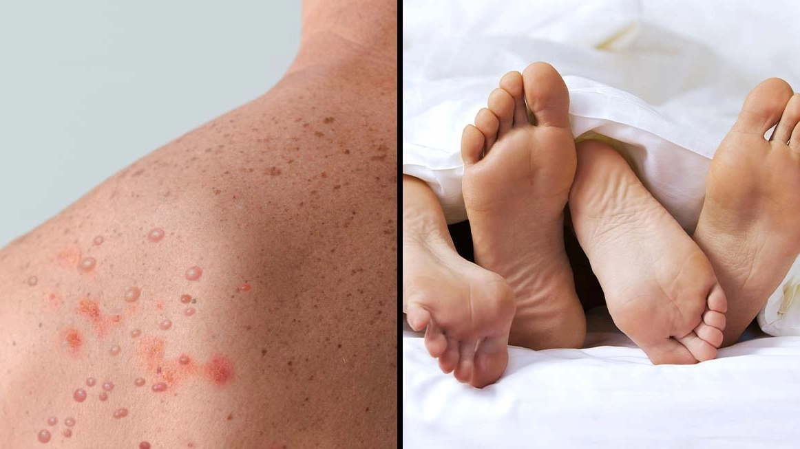 CDC Issues Baffling Guidelines On How To Have Sex With Monkeypox