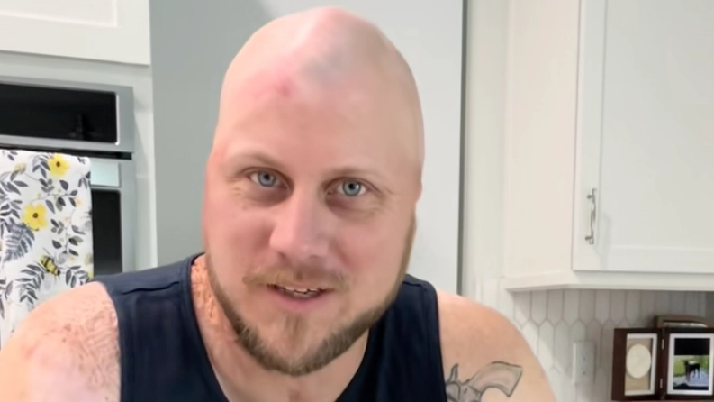 Man whose 'skull melted' after horror 4,160 volt electrocution reveals shocking injuries