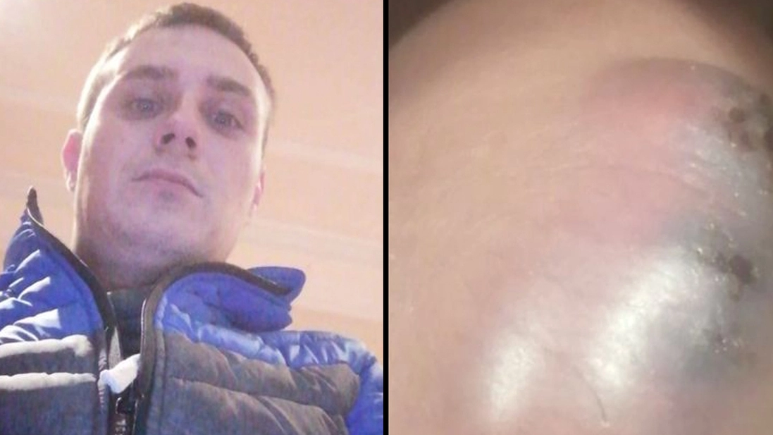 Man Feared He’d Lose His Penis After Being Bitten By Black Widow Spider