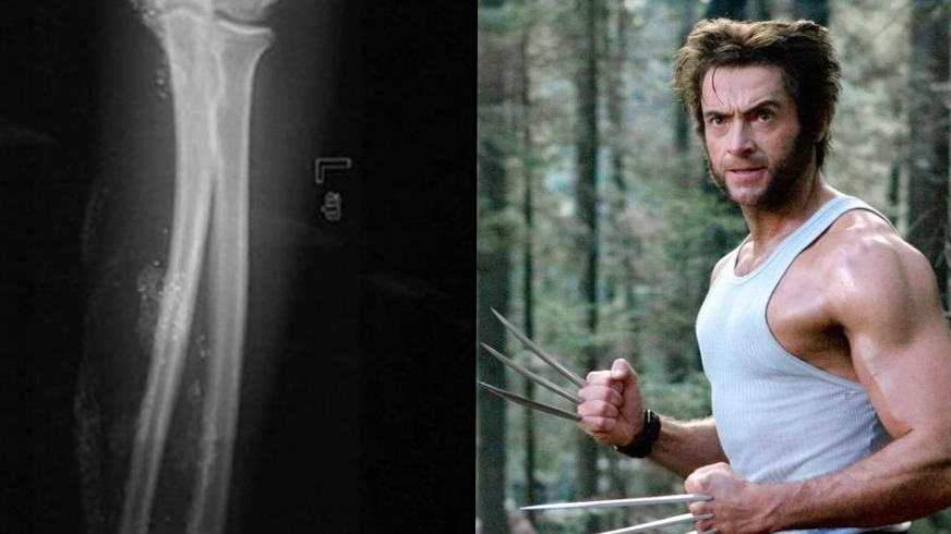 Teen hospitalised after injecting himself with mercury in attempt to become X-Men hero