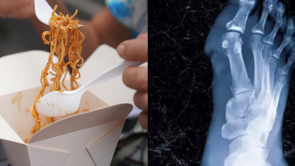 Student had to have limbs amputated after eating roommate's leftover noodles