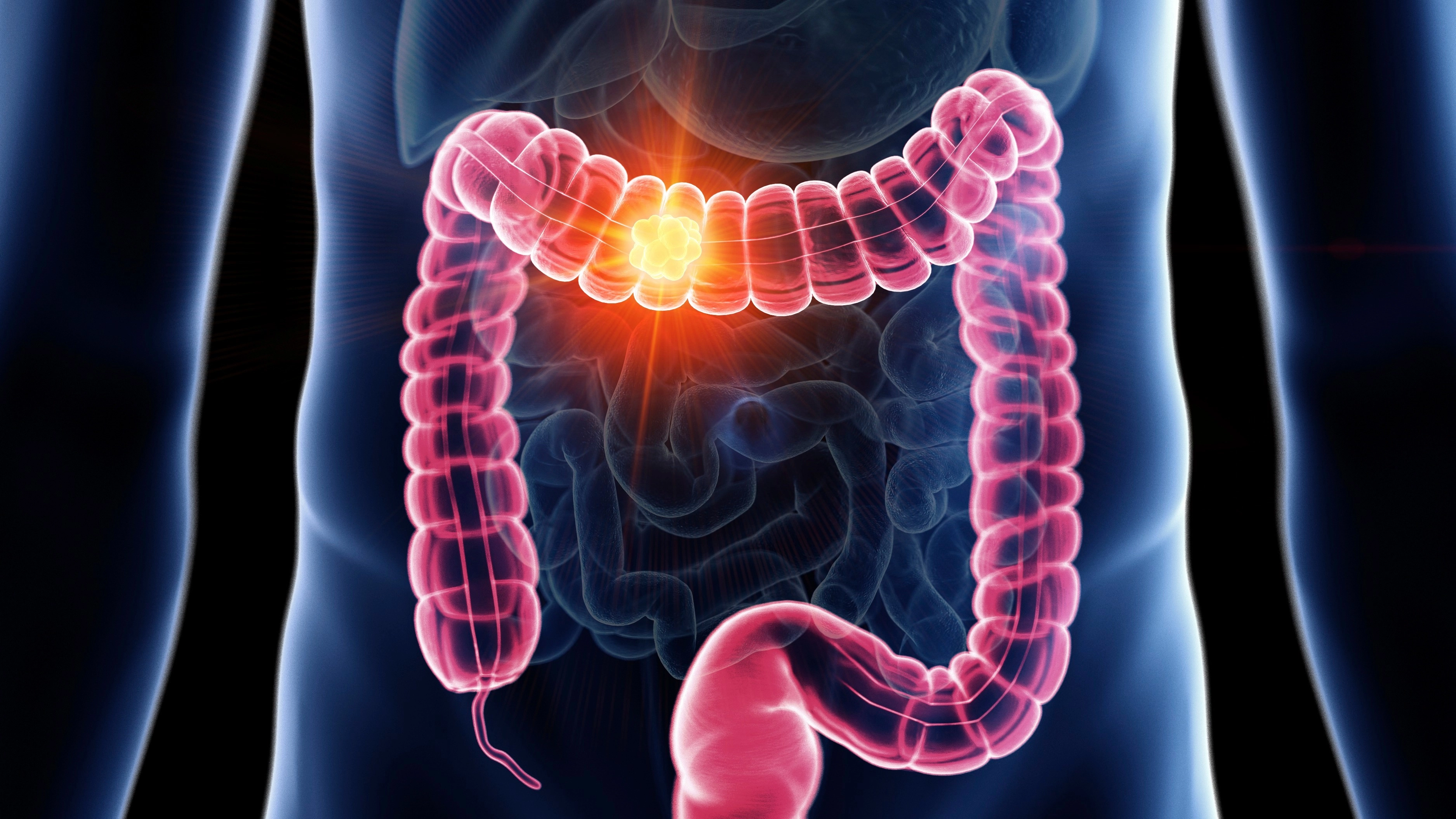 Study finds possible cause of unexplained colon cancer rise in young people