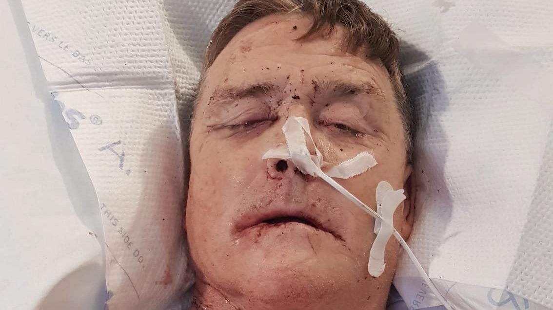 Symptoms of mouth cancer after man spotted unusual warning sign in his teeth that led to shock diagnosis