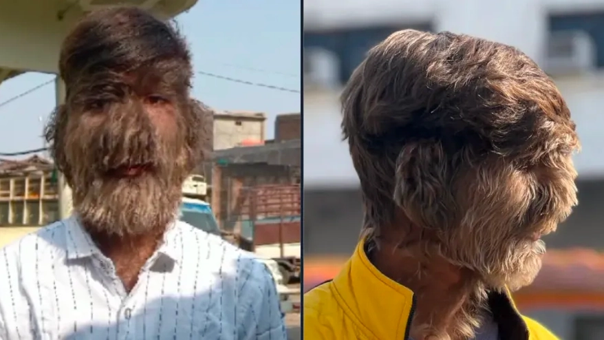 Teen born with 'Werewolf Syndrome' was covered in hair immediately after being born