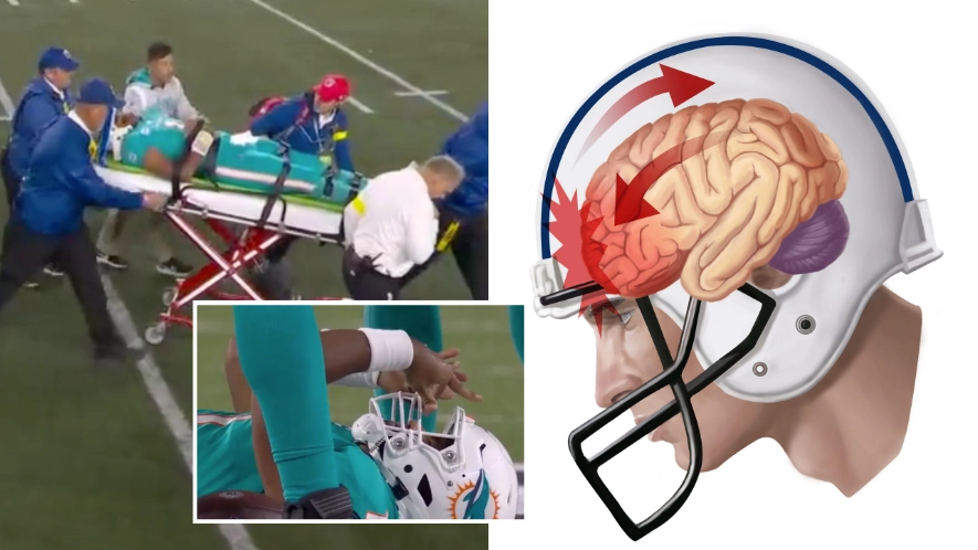 US health body officially acknowledges link between collision sports and CTE in historic ruling