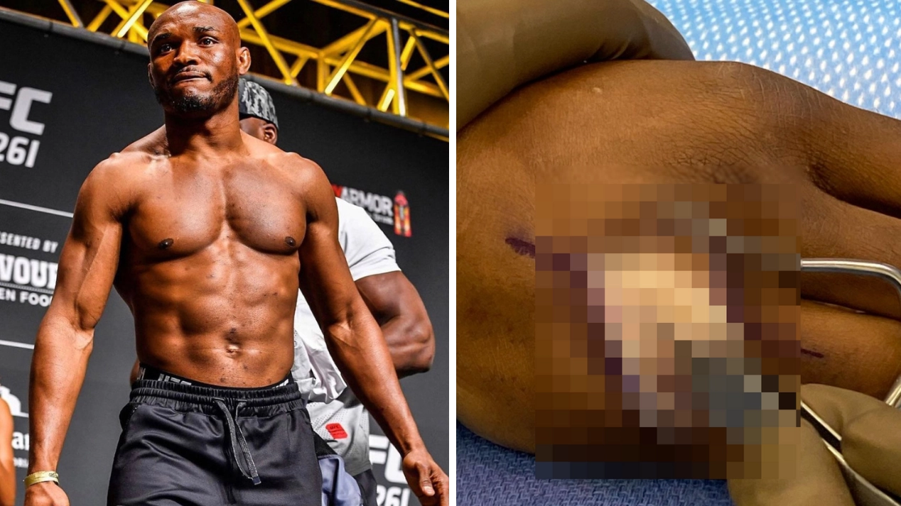 UFC President Dana White Shares Gruesome Photos Of Kamaru Usman's Hand Surgery