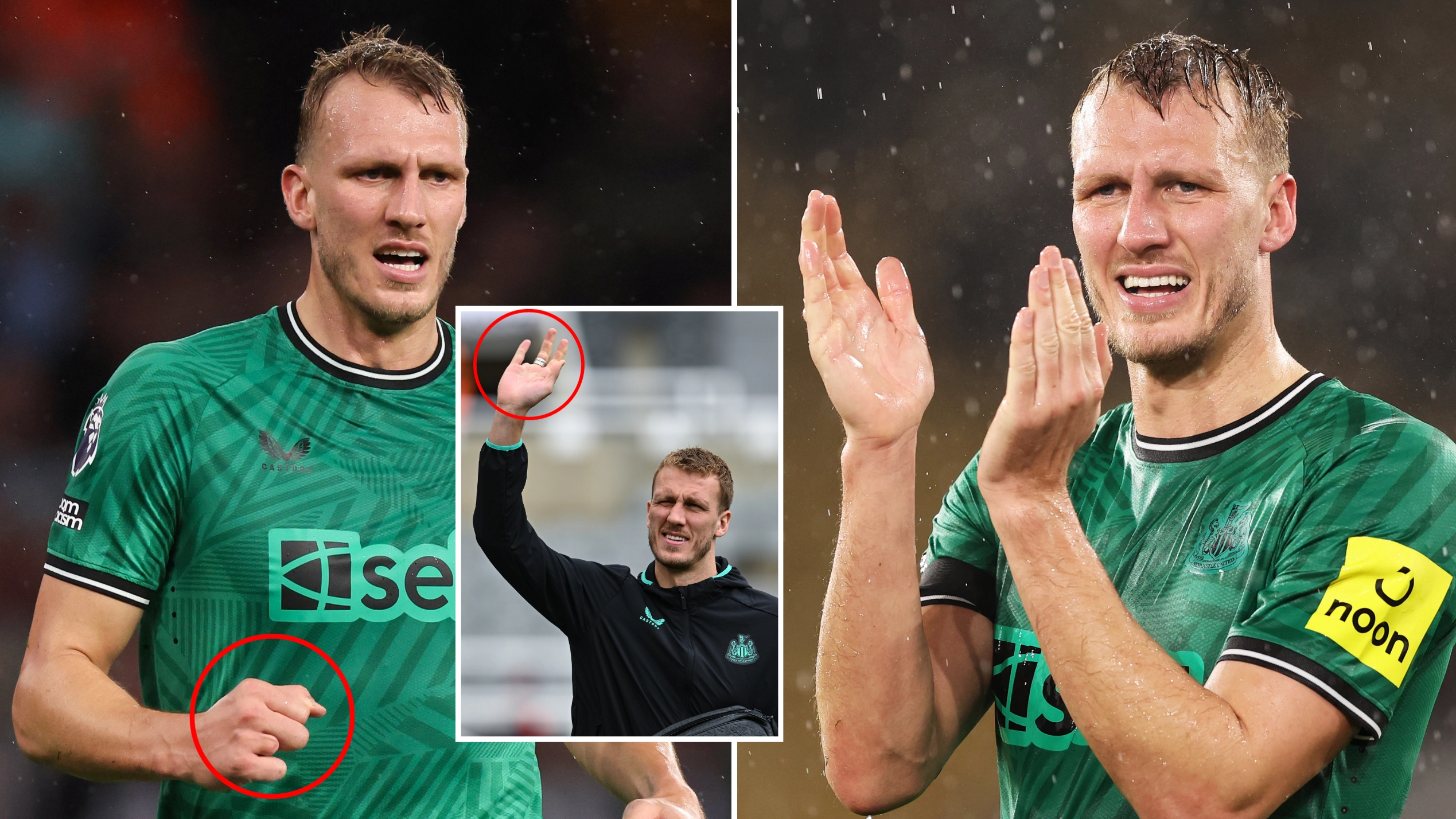 Why Dan Burn only has nine fingers after gruesome childhood accident