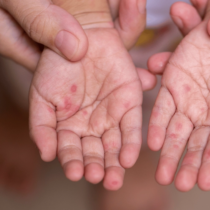 Health officials issue warning over 'very contagious' disease spreading across US state