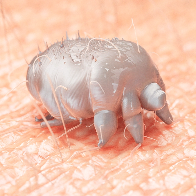 Highly contagious condition where microscopic mites burrow underneath your skin sees sharp rise