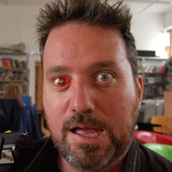 Man who replaced his lost eye with a wireless camera explains why he did it