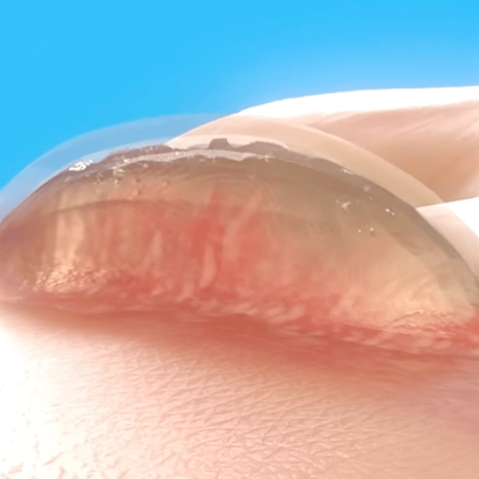 Disgusting simulation shows exactly why you should never pop a blister