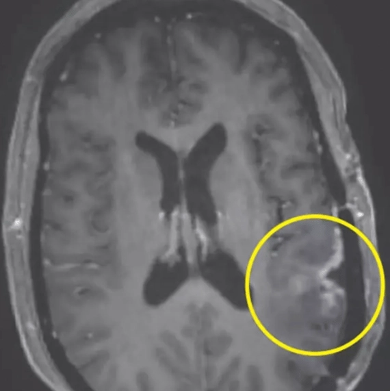 Astonishing cancer breakthrough sees woman's brain tumor almost disappear in just five days