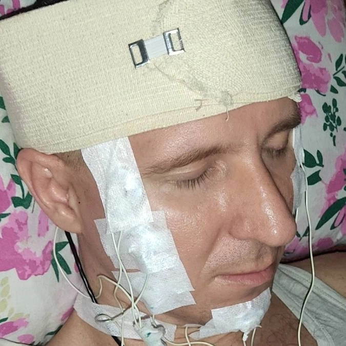 Man who performed neurosurgery on himself to help 'control' his dreams suffered horrifying consequences