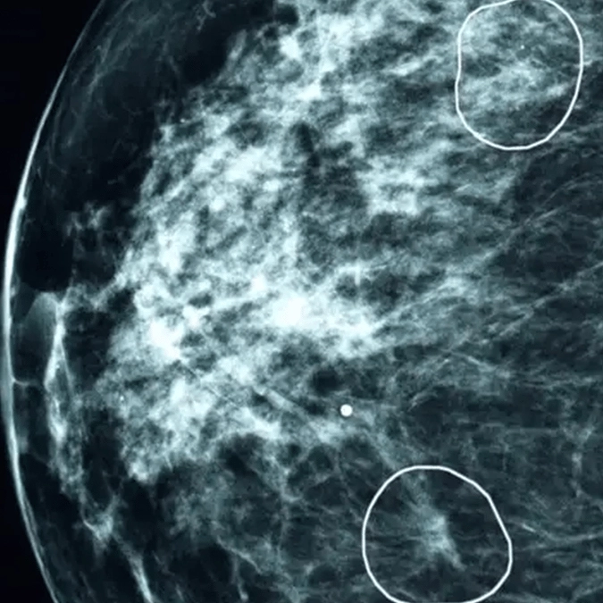 Landmark trial of 700,000 women begins after AI detected breast cancer 5 years before it even developed