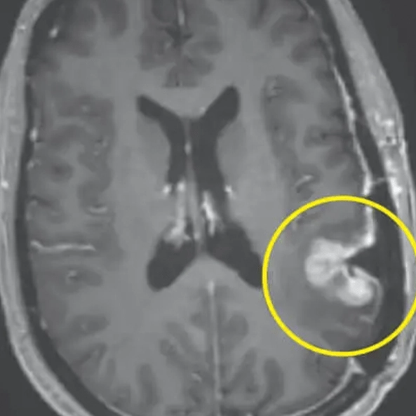 Incredible cancer breakthrough sees woman's brain tumor almost disappear in just five days
