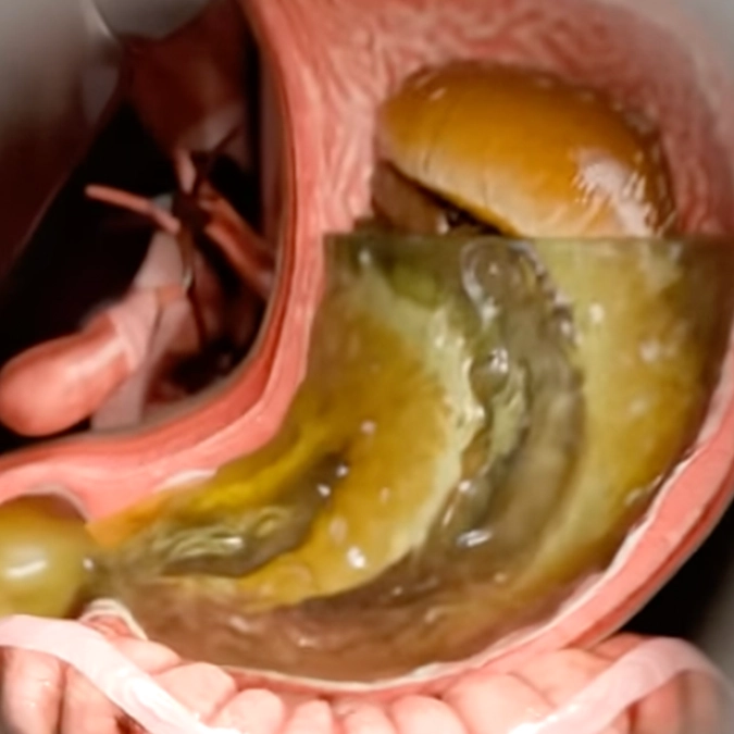 Disturbing simulation reveals what really happens to your body after injecting Ozempic
