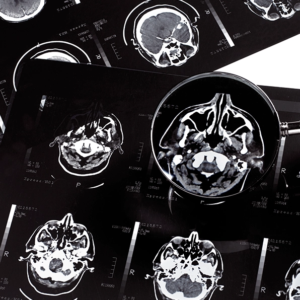 Scientists warn neurological diseases are getting worse as climate change increases
