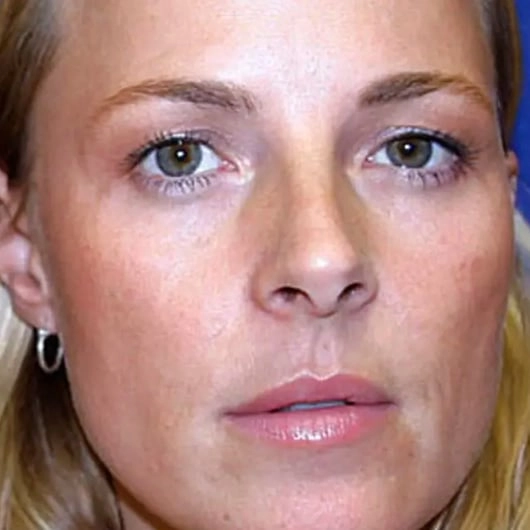 Identical twins share astounding results after one used Botox for 20 years while the other didn't