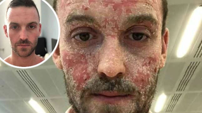 Man With Eczema Shows Incredible Transformation After Ditching Steroid Medication