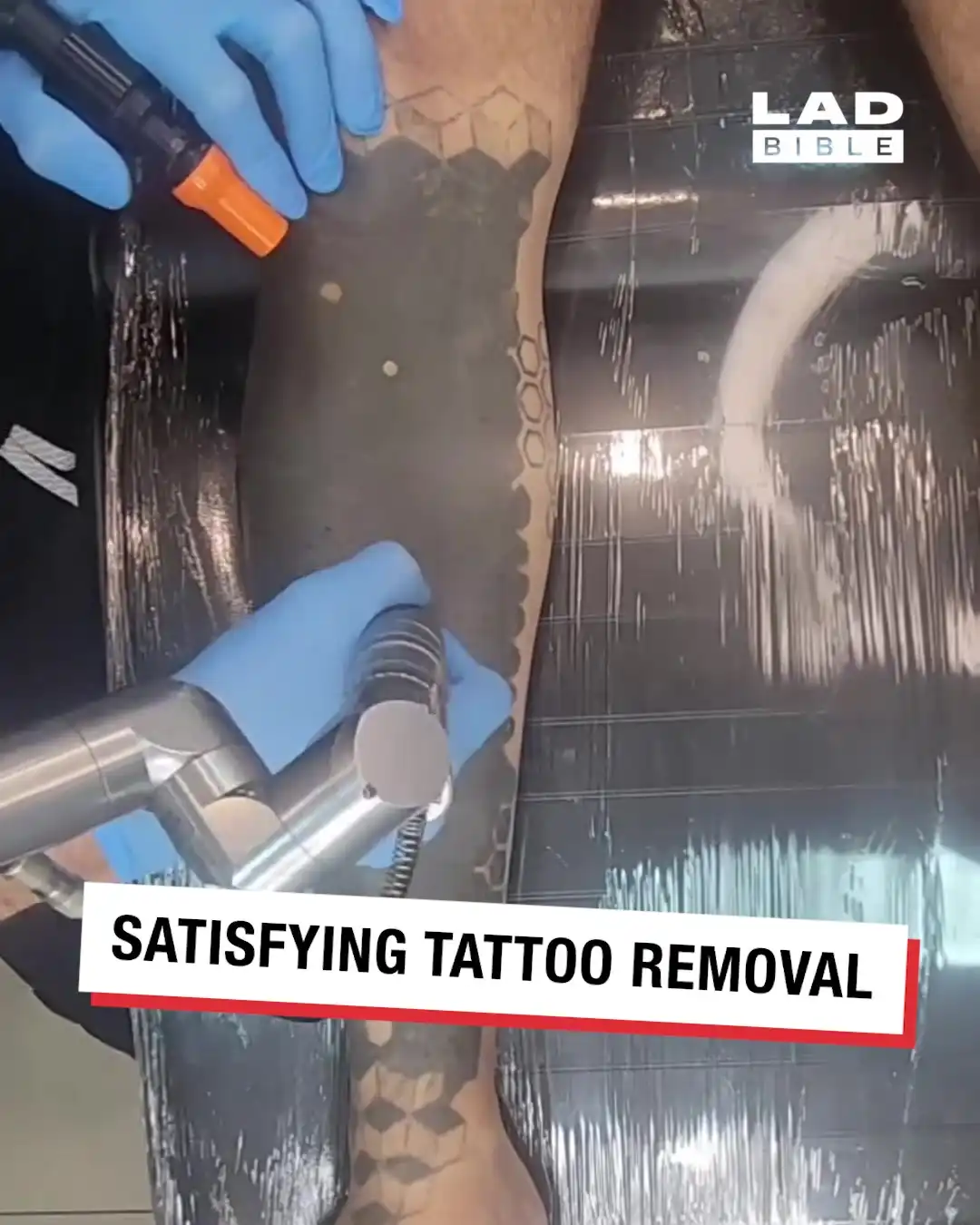Tattoo removing