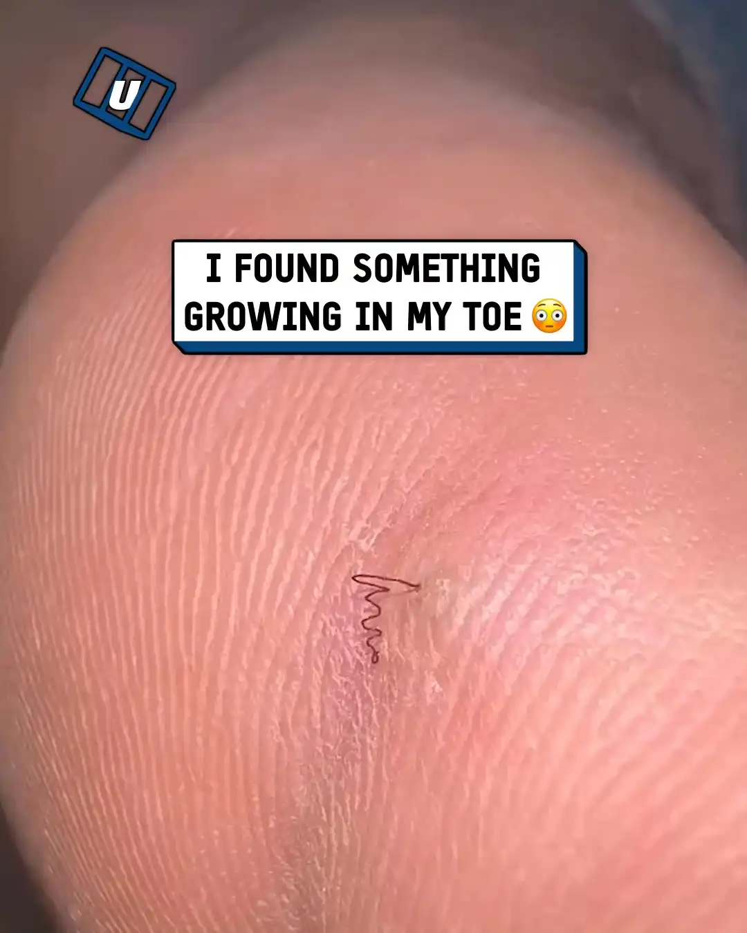 Mysterious hair growing on toe π¦Άπ²