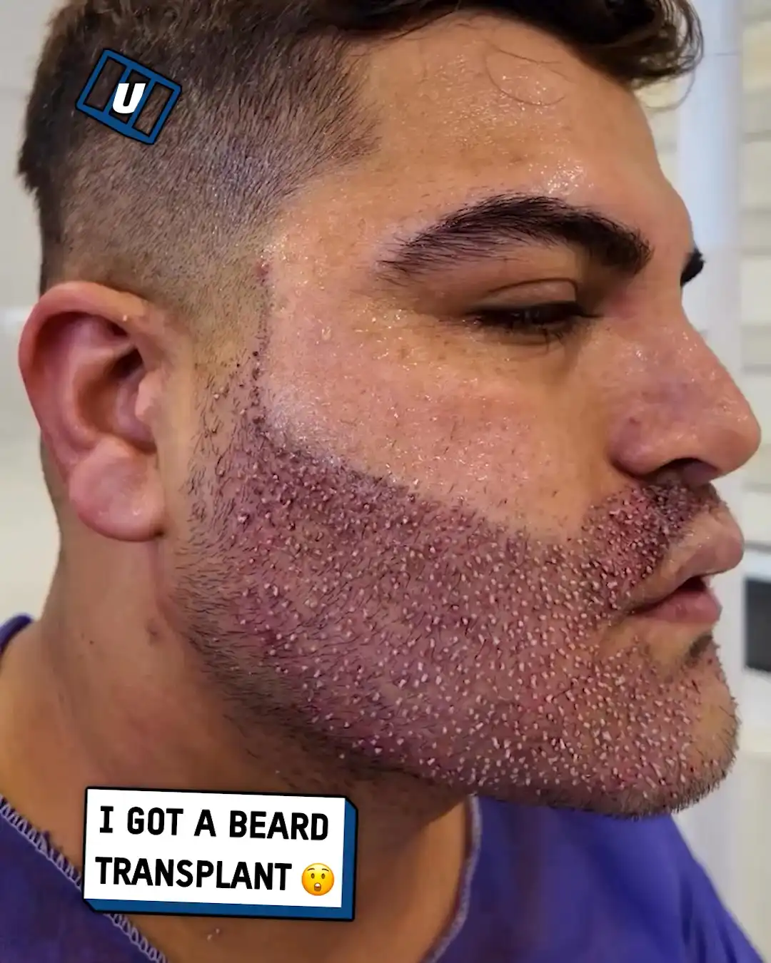Beard transplant π§ββοΈπ€―