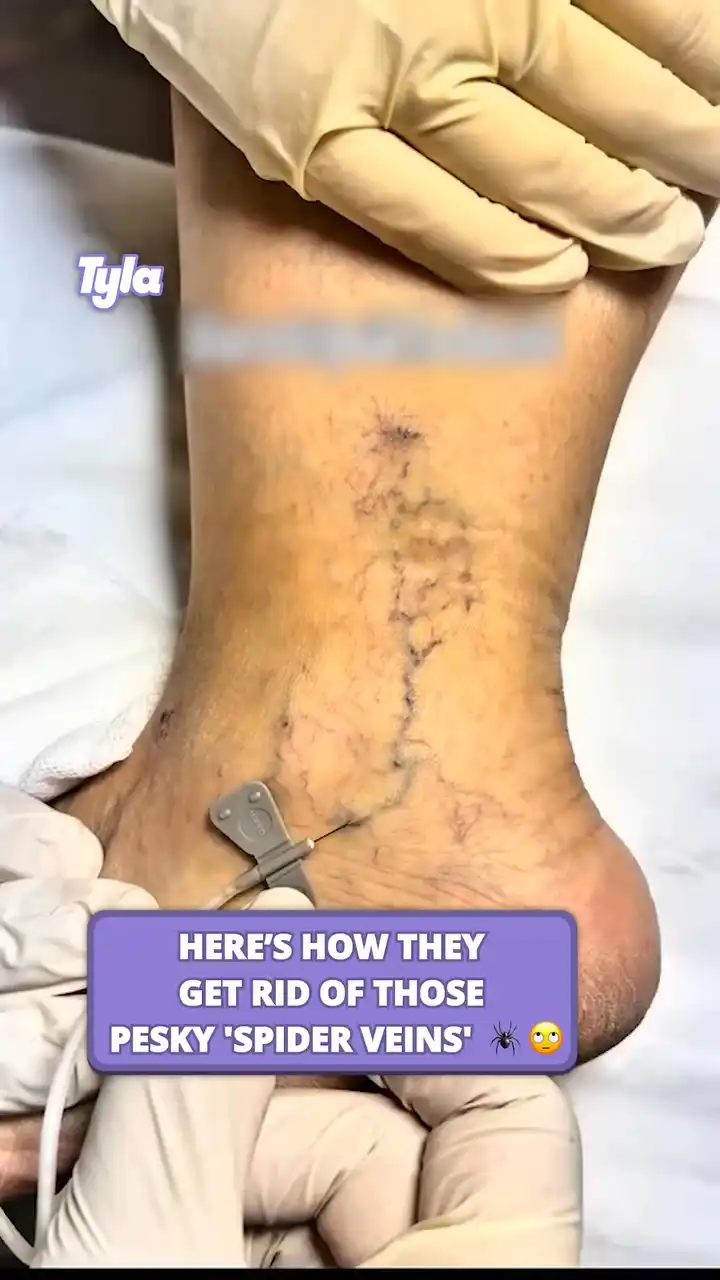 No more 'spider veins' for me π€©π·οΈ