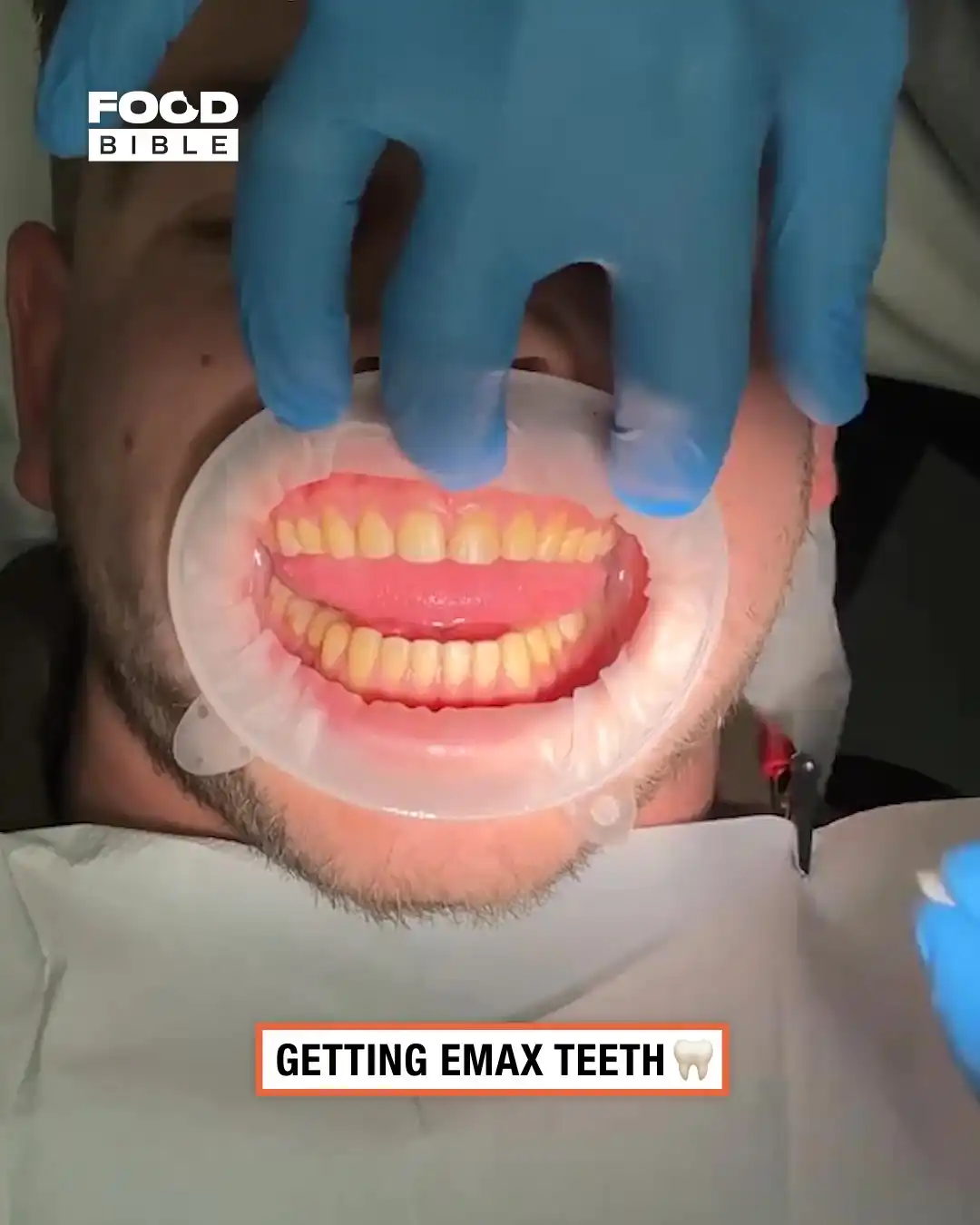 Emax teeth 🦷