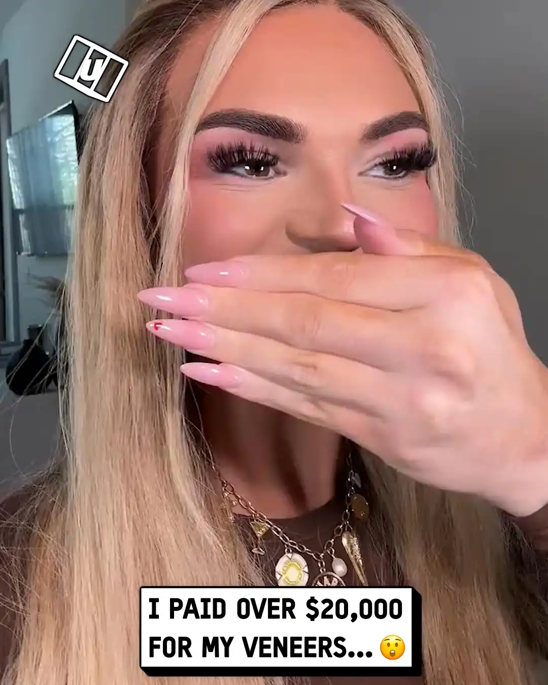 Woman with over the top veneers