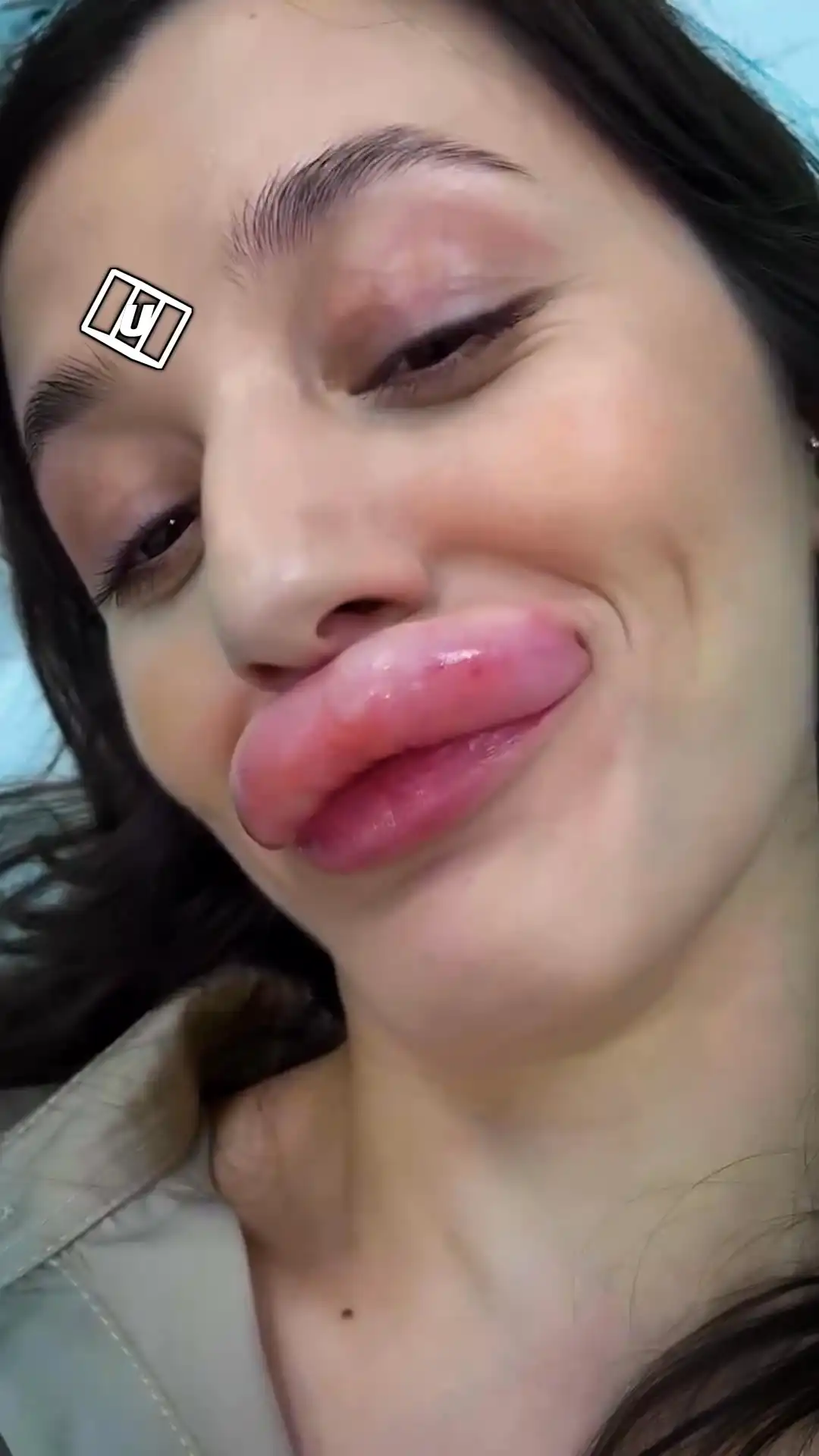 Boyfriend loses it over lip filler fail