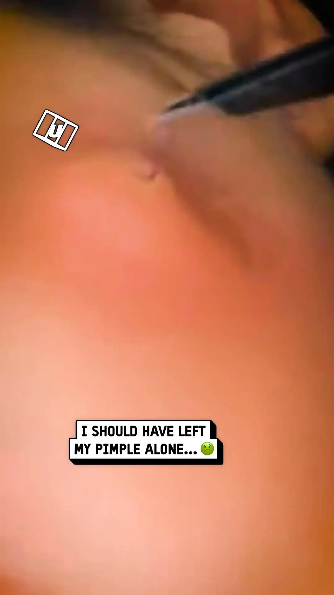 Can't believe this came out of my pimple