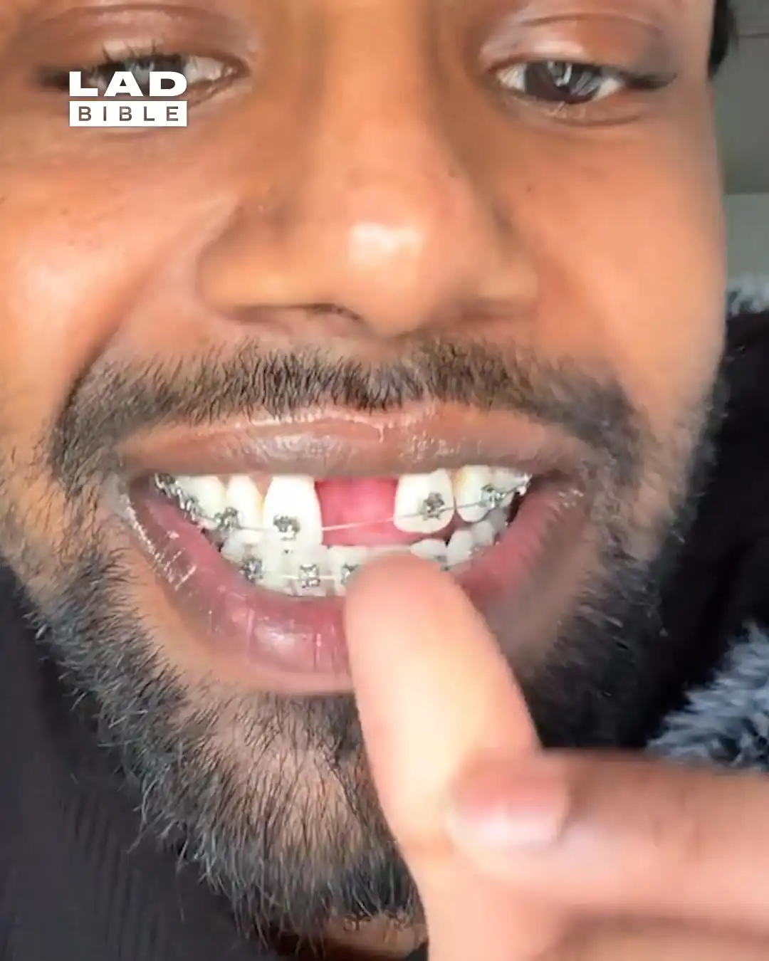 My Braces Broke 🦷😨