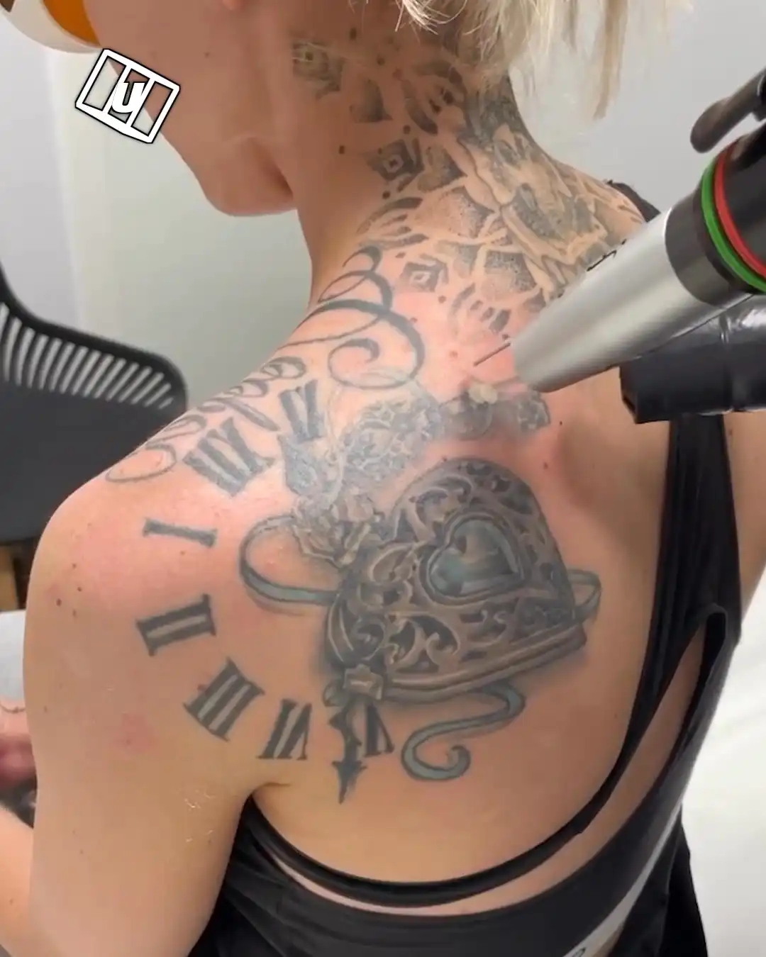 Giant back tattoo removal