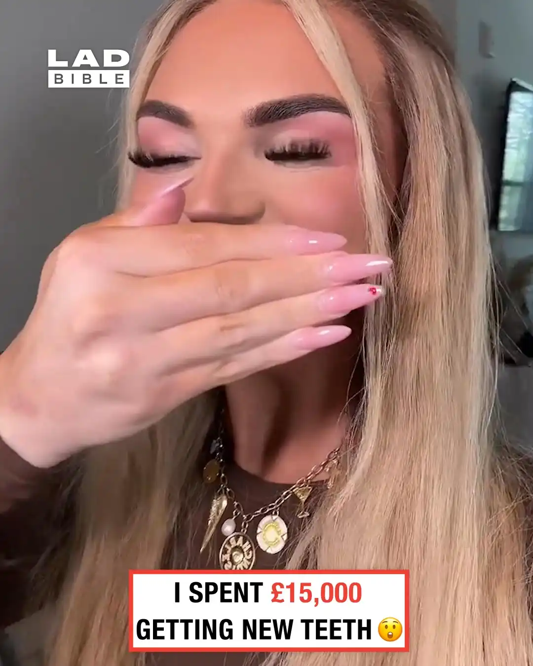 Woman Has Over the Top Veneers 🦷