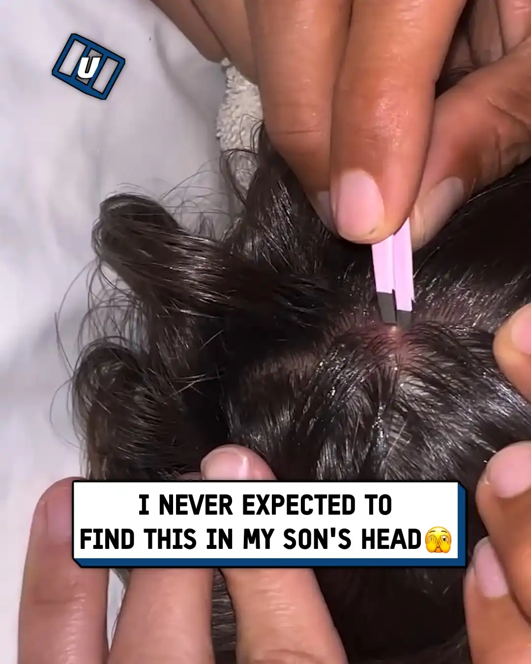 Bot fly pulled from son's head 🪰😰
