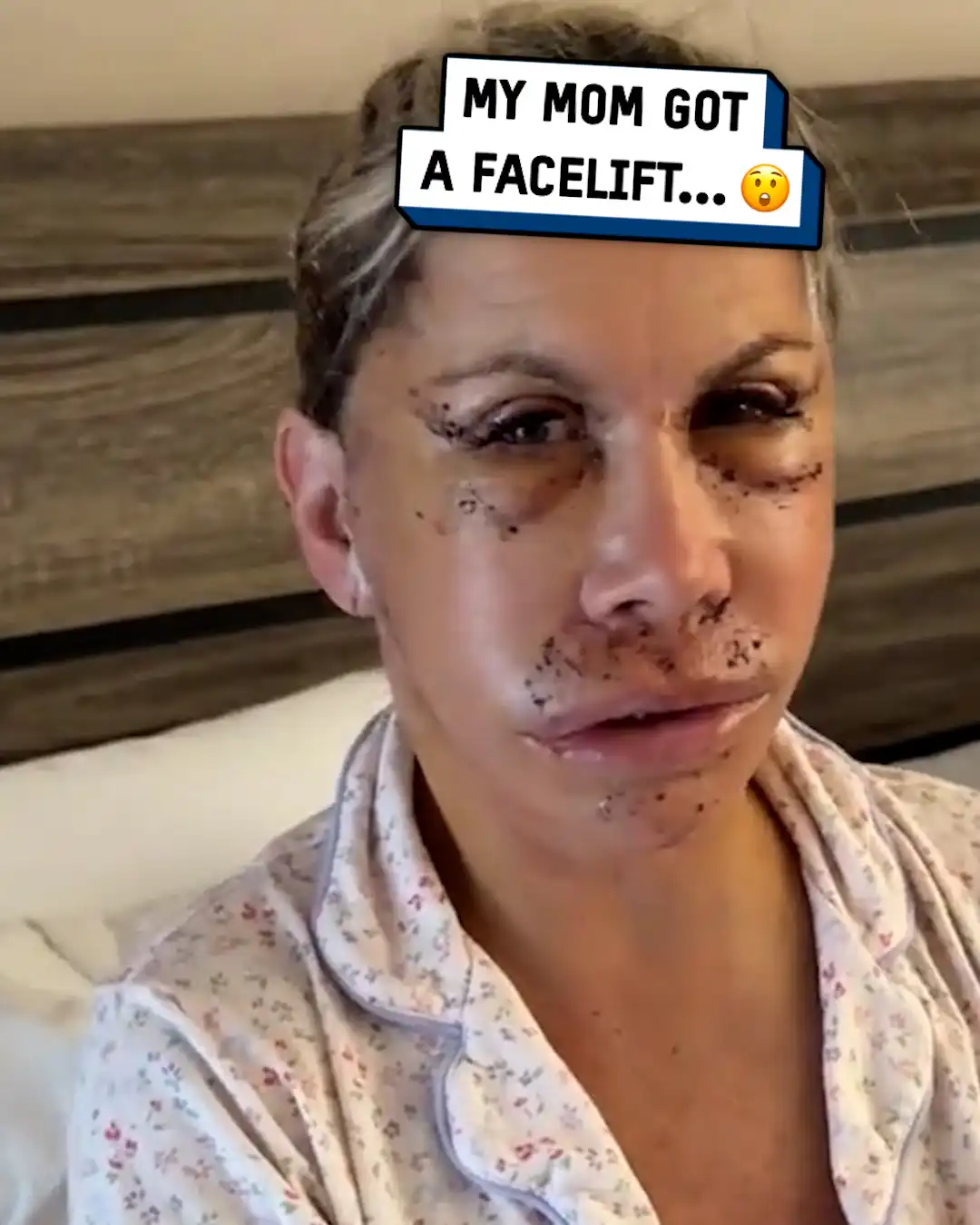 Mom's facelift recovery 😱🩺