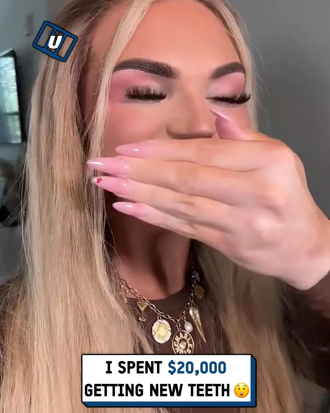 Over the top veneers 🦷😳