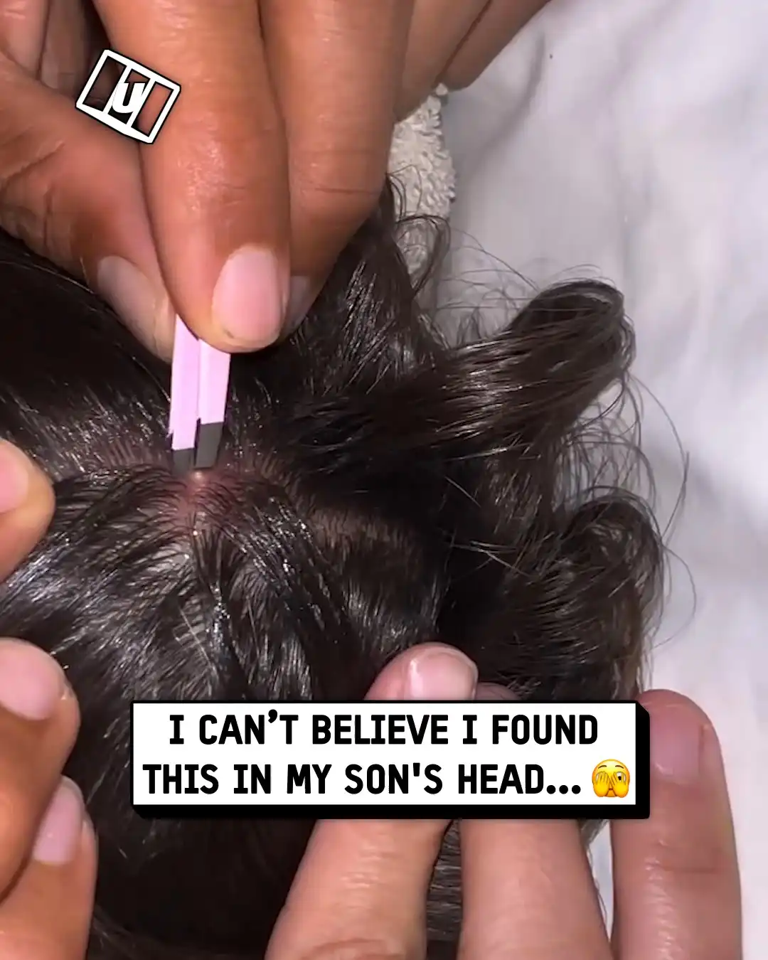 My Son Had a Bot Fly in His Head 😨